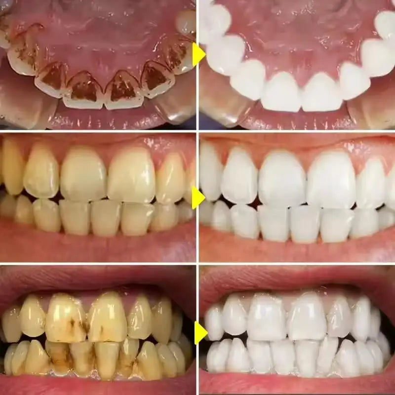 Blanchiment Dentaire Professionnel – Essence Anti-Taches pour Dents, Appareils et Prothèses