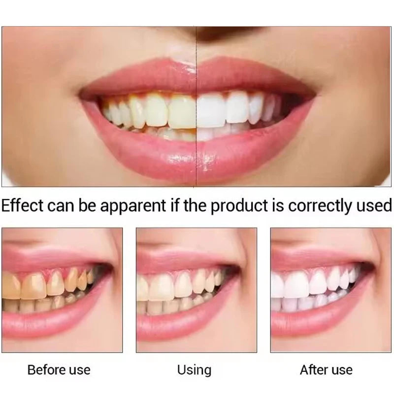 Blanchiment Dentaire Professionnel – Essence Anti-Taches pour Dents, Appareils et Prothèses